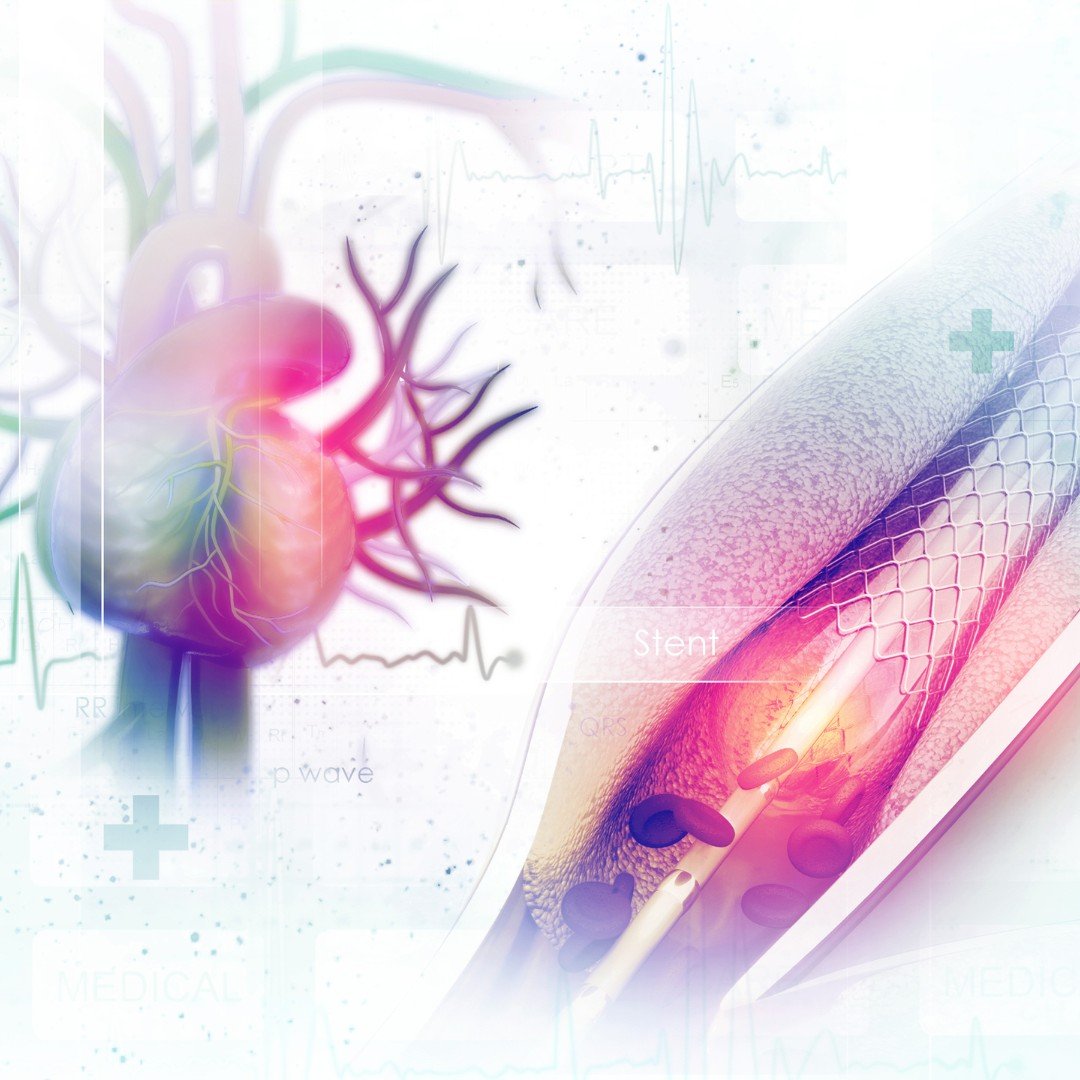 Difference Between Angioplasty and Bypass Surgery
